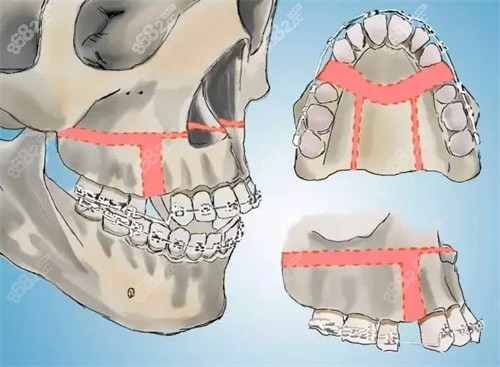郑广森正颌手术做的怎么样做的复杂正畸正颌费用贵不