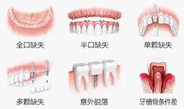 杭州时光口腔做种植牙多少钱一颗要结合牙齿问题来定