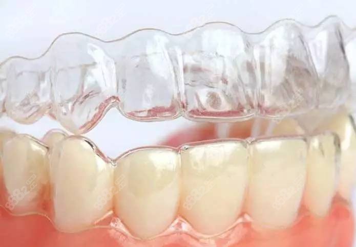 透明隱形牙套的費用是多少錢