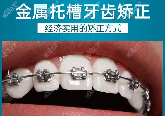 大連潔雅口腔金屬托槽牙齒矯正價格
