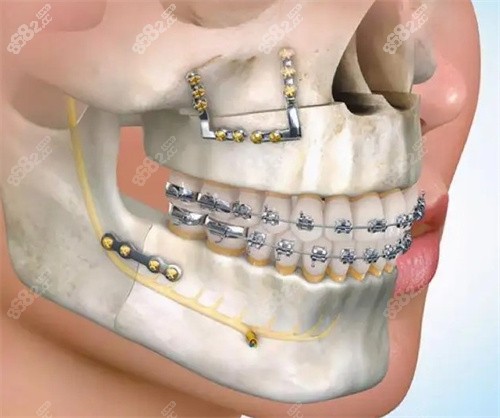郑广森正颌手术做的怎么样做的复杂正畸正颌费用贵不