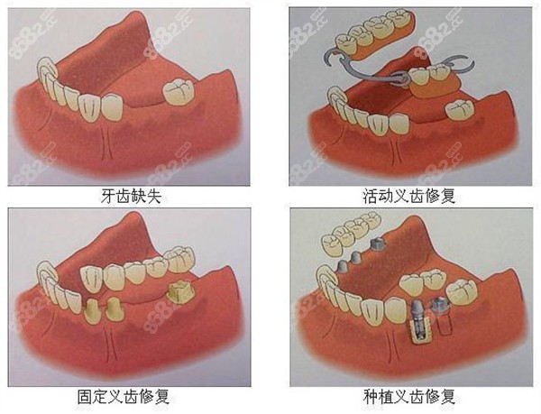 镶牙价格表
