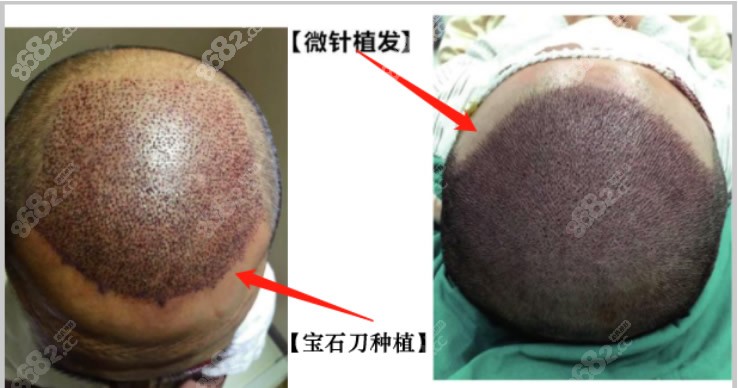 重庆新沐植发多少钱一个单位医院微针不剃发植发价格来了
