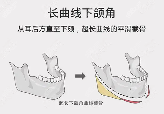 长曲线下颌角截骨的优势