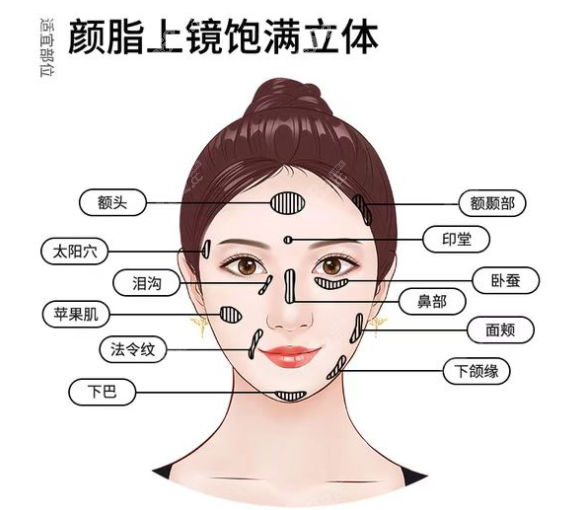 银川华美可以做脂肪填充面部哪些部位