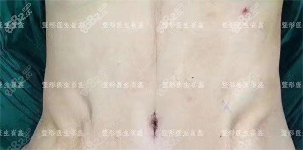 西安<!--<i data=20240705-sp></i>-->医生腹壁成形手术实例