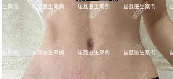 西安<!--<i data=20240705-sp></i>-->医生腹壁成形手术实例