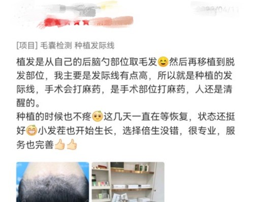 广州倍生植发怎么样？