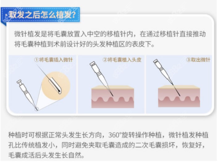 重庆新沐微针种植发际线过程和步骤