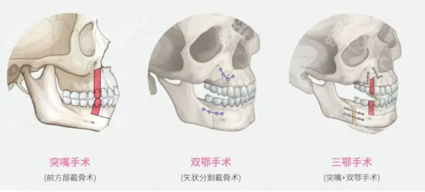 骨性凸嘴矫正手术图示