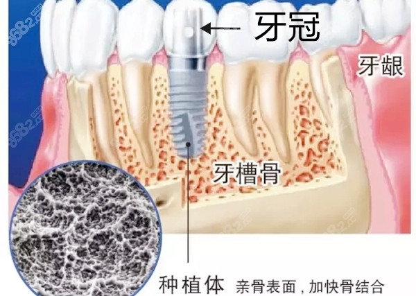 种植牙和牙冠在牙槽骨内的图