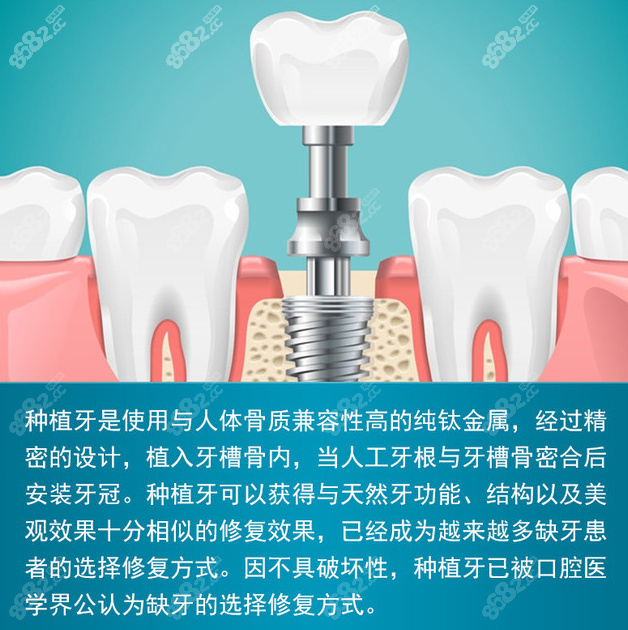 广州中家医口腔种牙收费