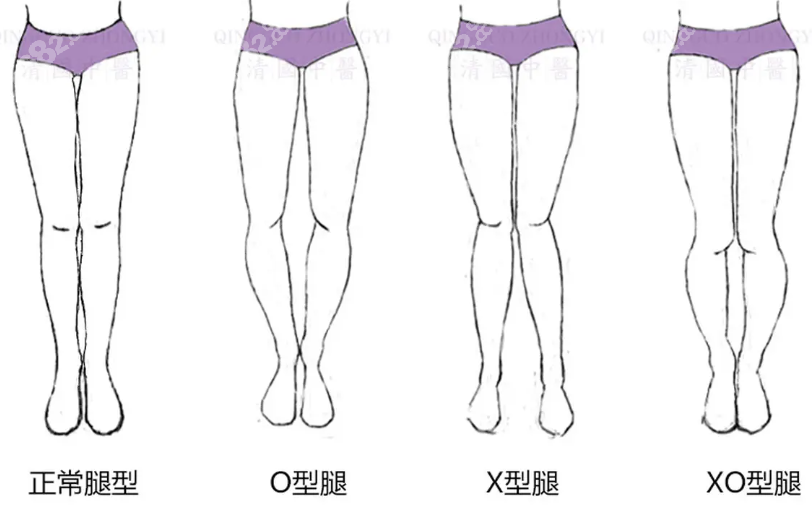 O/X型腿型
