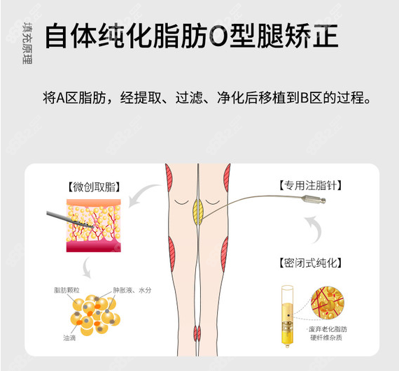 自體純化脂肪OX型腿矯正術(shù)