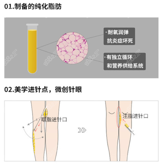 北京润美玉之光脂肪矫正腿型