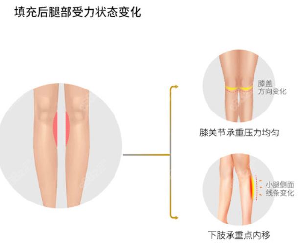 北京润美玉之光脂肪矫正O型腿后的对比