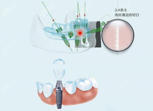 数字化微创种植牙技术特色