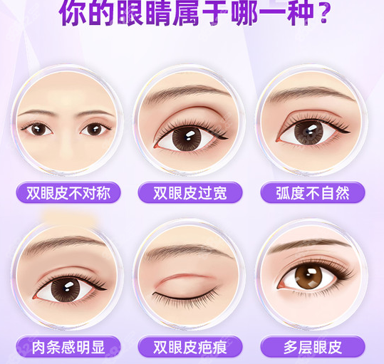 济南韩氏双眼皮修复的类型