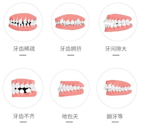 <!--<i data=20240705-sp></i>-->牙科牙齿矫正适应人群