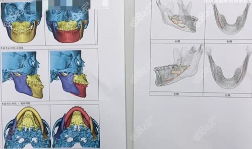 广州广大医院歪脸矫正前后对比照