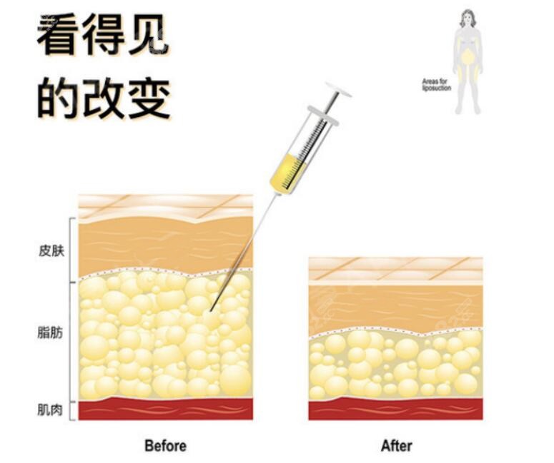 抽脂前后变化图片