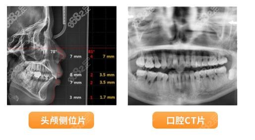 合肥华美口腔种植牙技术挺可以的