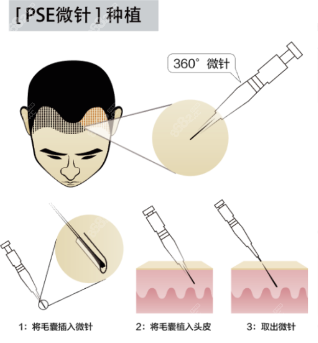 大麦微针PSE微针植发技术