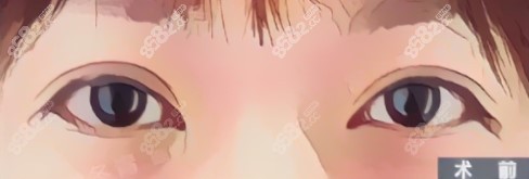 找北京<!--<i data=20240705-sp></i>-->医生修复双眼皮术前照片