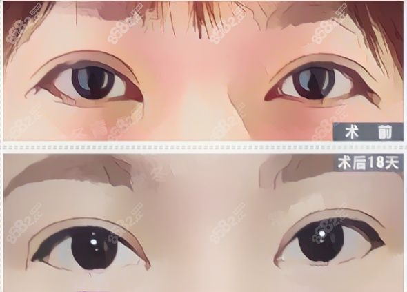 北京<!--<i data=20240705-sp></i>-->高难度修复双眼皮实例