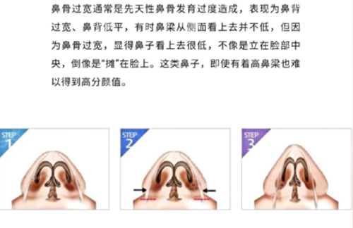 鼻骨内推手术可以解决鼻背宽问题