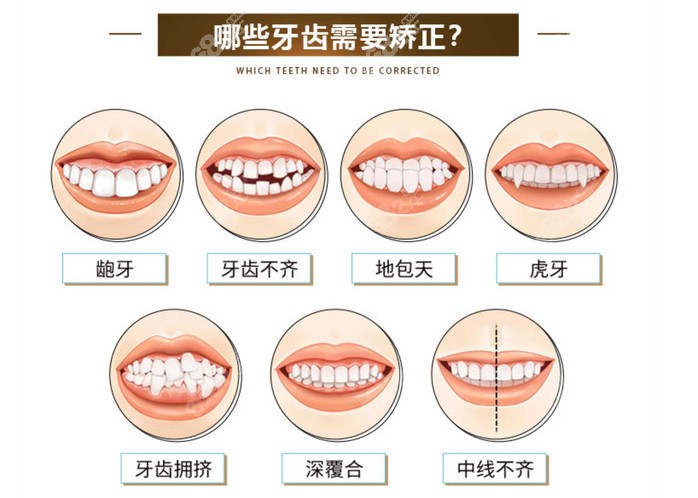 深覆合、龅牙等牙齿情况都可以通过牙齿矫正进行改善