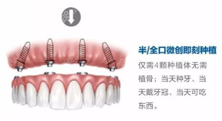 清华阳光口腔的即刻种植技术