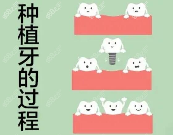 北京京立口腔种植牙费用是多少