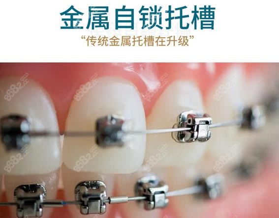 包头金属自锁托槽多少钱