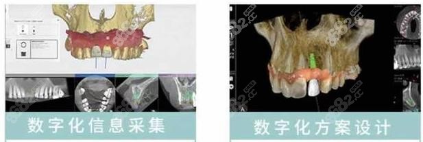 株洲湘安口腔医院挺好因为做种植牙好