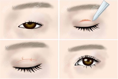 鲁华医生做双眼皮手术的技术优势3