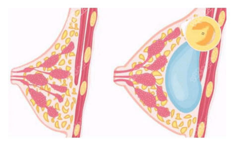 假体隆胸的植入位置