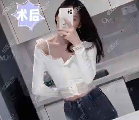 土麦森吸脂术后