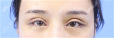 聂丽丽医生做双眼皮手术的技术优势2