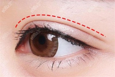 鲁华医生做双眼皮手术的技术优势5