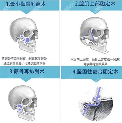 韩国菲斯莱茵颧骨整形