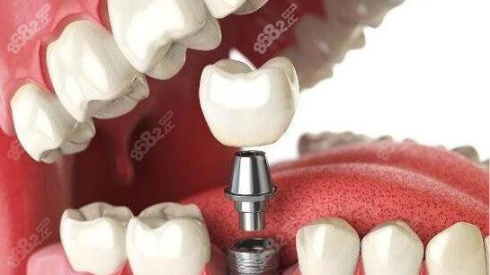 成都武侯区种植牙多少钱一颗 成都武侯区种植牙多少钱一颗