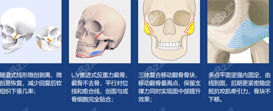 张笑天轮廓磨骨优势多