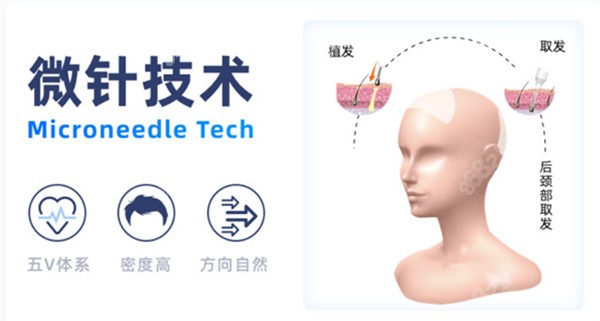 碧莲盛的微针植发技术