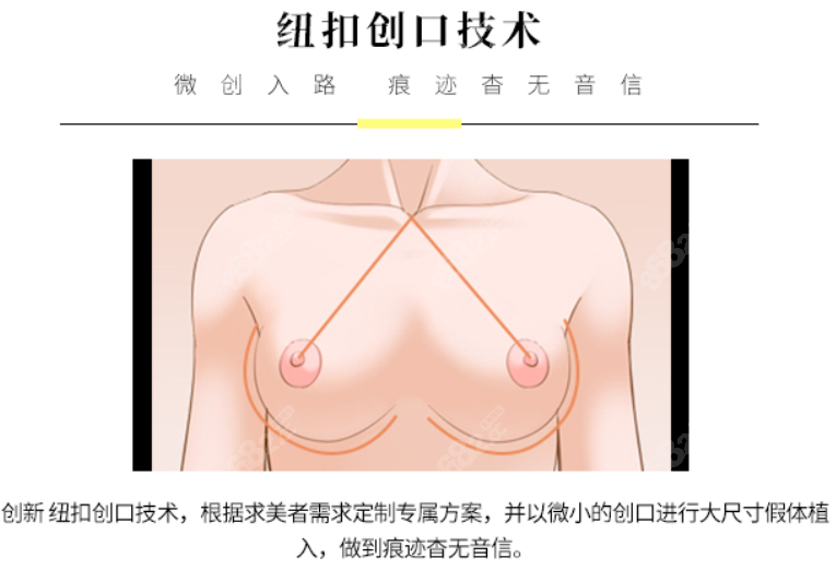 纽扣创口技术优势