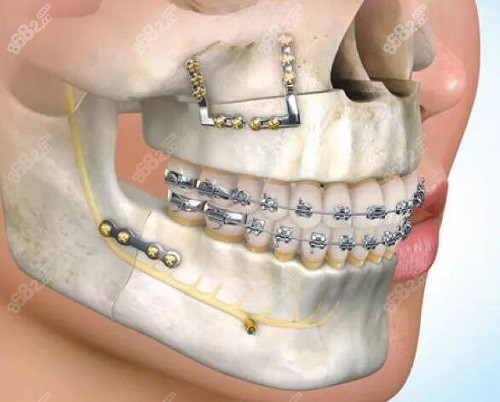 正颌手术