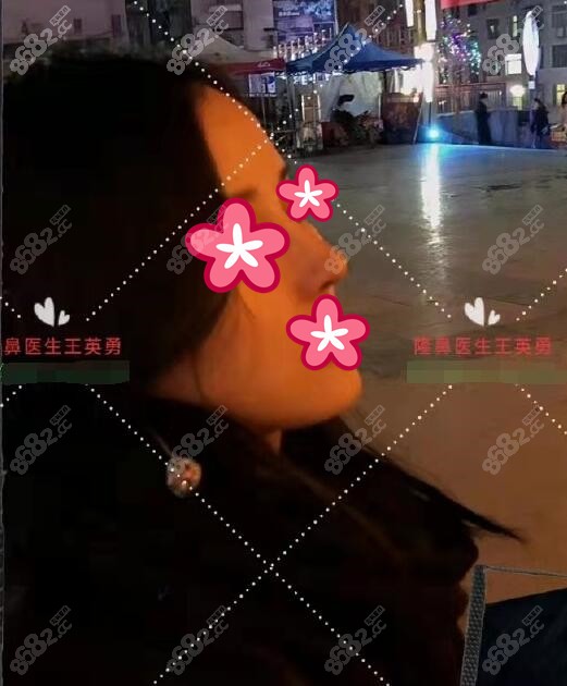 王英勇鼻修复术后照片