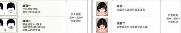 二级脱发植发建议的毛囊单位数量