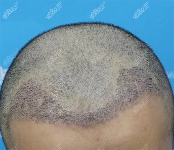 廣州倍生植發(fā)實(shí)例