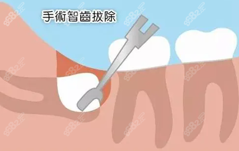 正规医院拔智齿收费标准